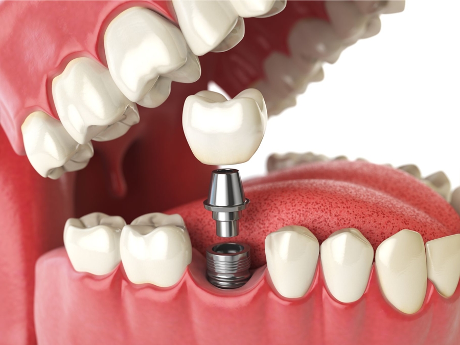 dental implants in Madurai